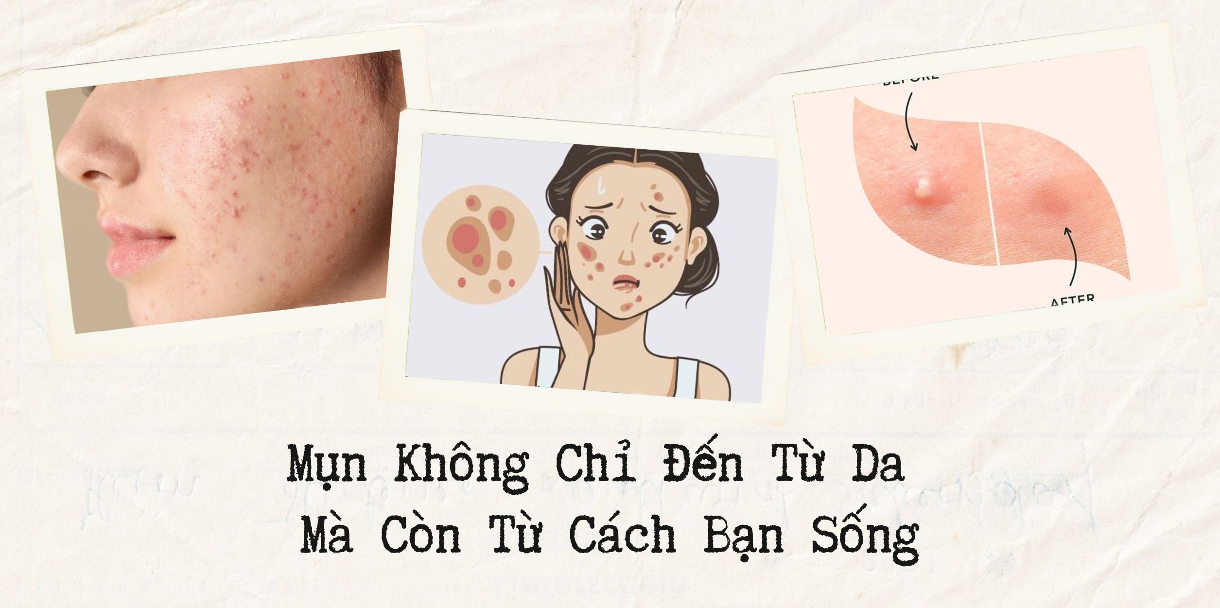 Mụn Không Chỉ Đến Từ Da, Mà Còn Từ Cách Bạn Sống